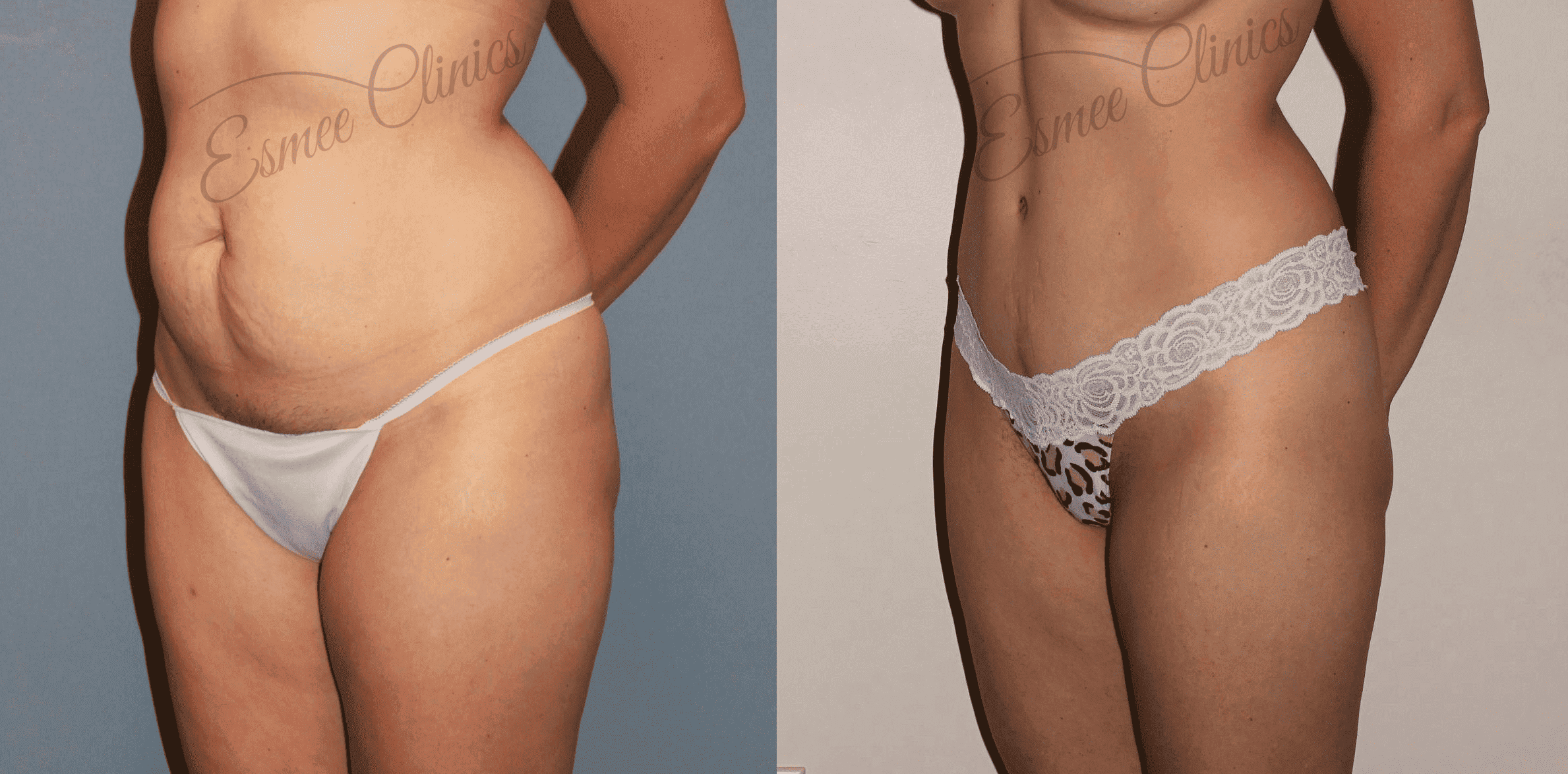 Before and After img